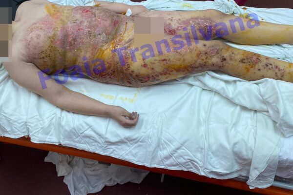 Femeia din Dej care și-a lăsat copilul să putrezească la propriu, a fost arestată! Imagine cu copilul din spitalul din Cluj!