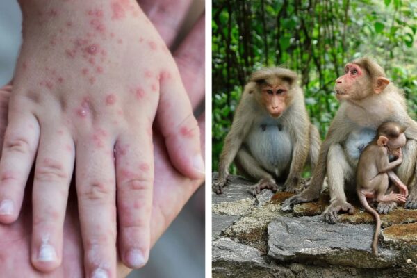 ALERTĂ în Europa după ce au apărut zeci de cazuri suspecte de „variola maimuței”. Care sunt simptomele
