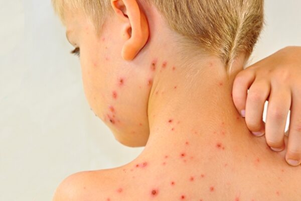 Ministerul Sănătății a dat alarma. Epidemie națională de pojar