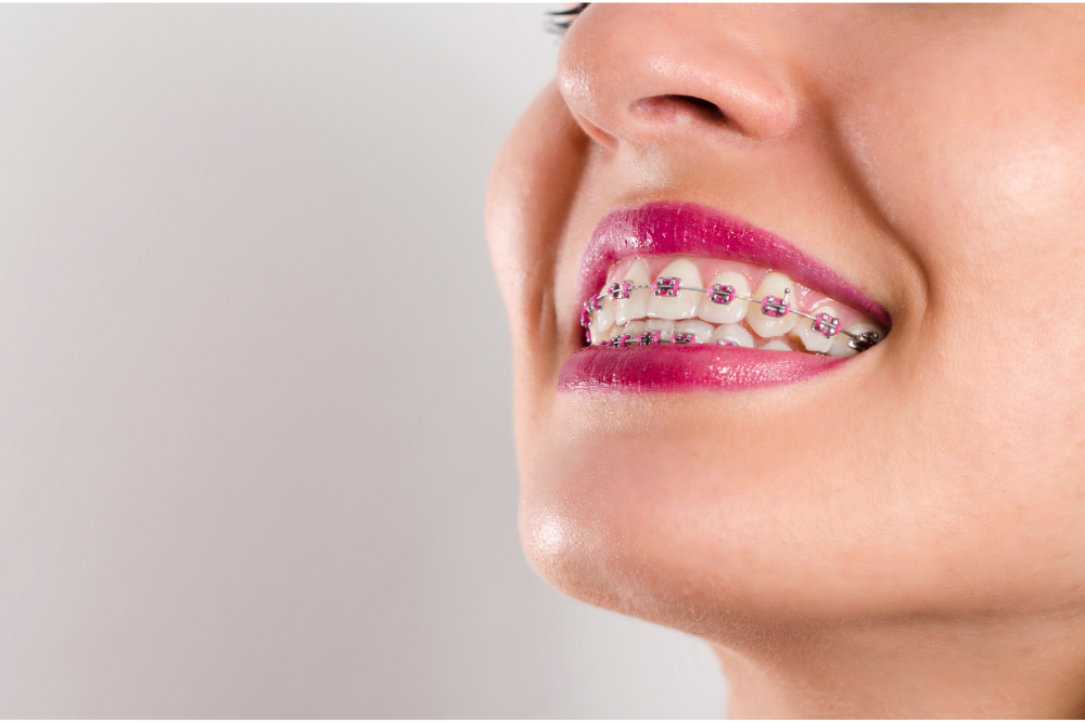 Aparatul dentar - îngrijire și curățare eficientă