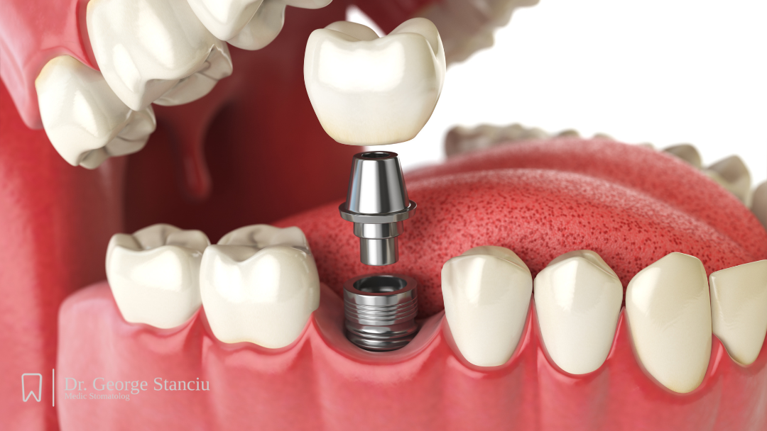 Implant Dentar în Cluj: Soluția permanentă pentru un zâmbet perfect la Stadent